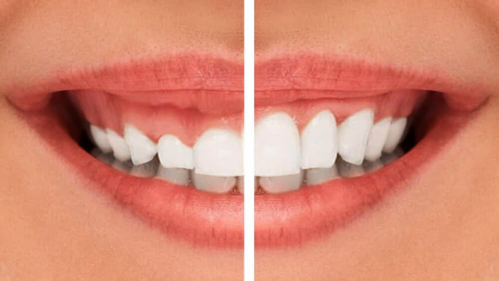 diseño sonrisa gingivoplastia