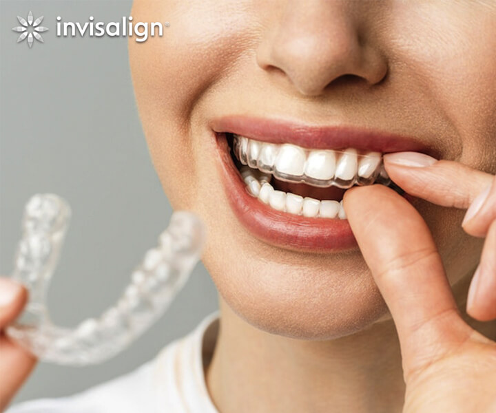 invisalign alineadores